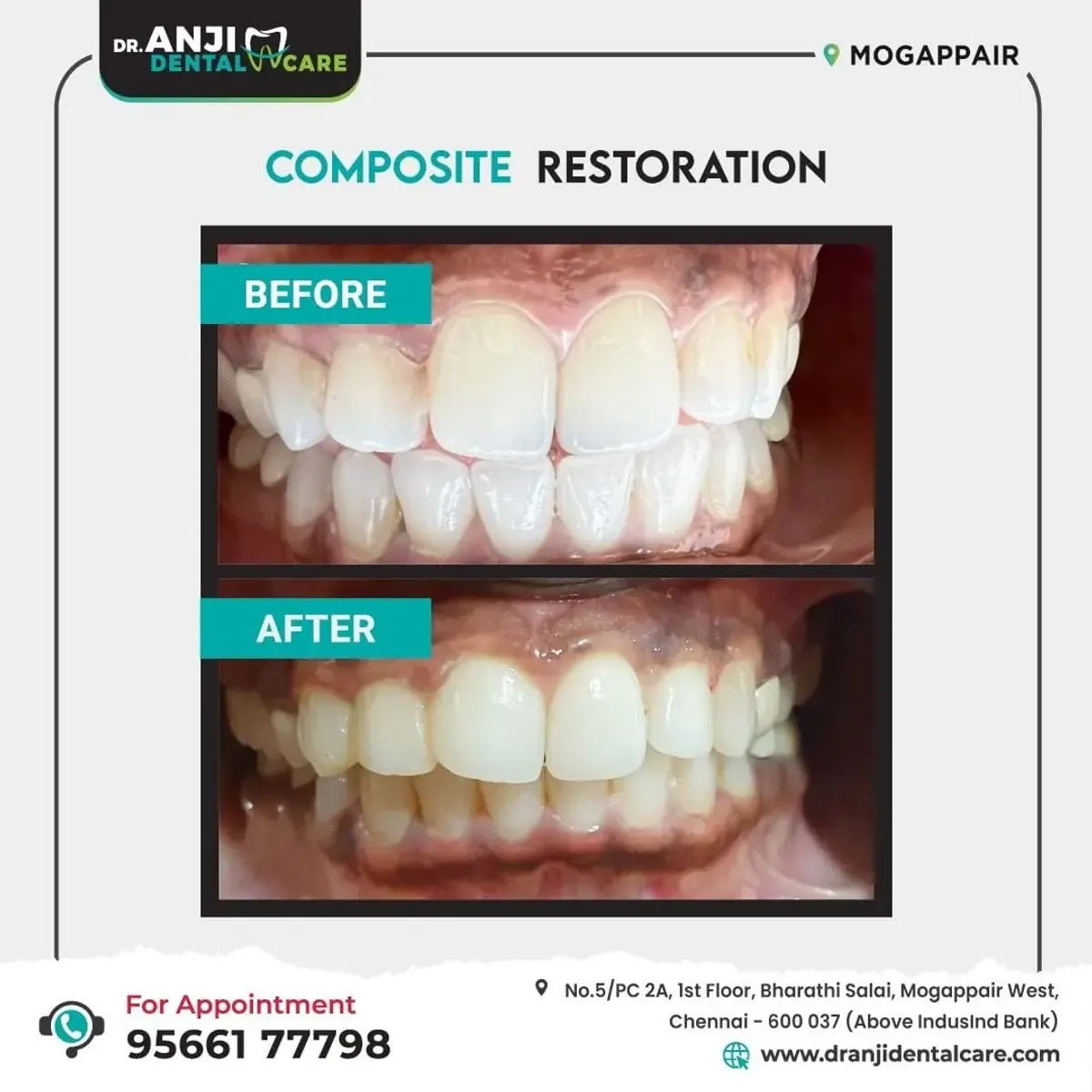 Composite Restoration Treatment