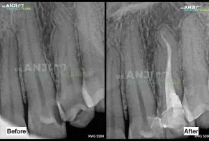 Curved Root Canal Treatment