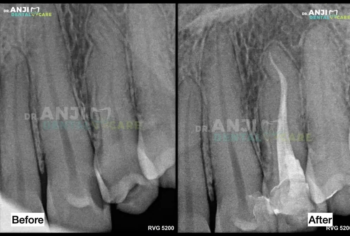 Curved Root Canal Treatment