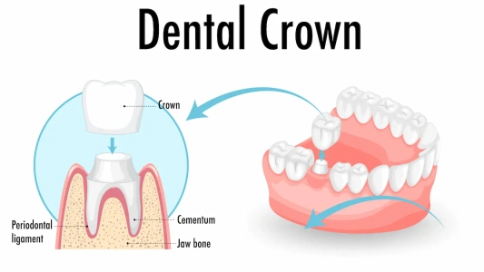 Dental Crowns in Chennai