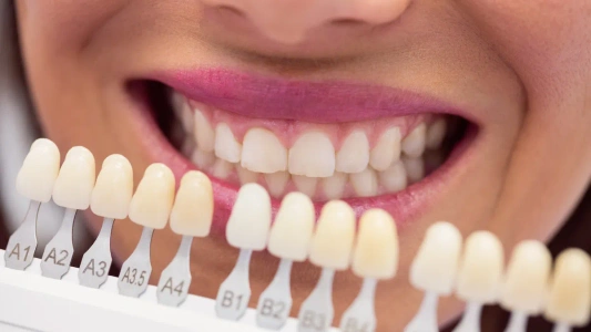 Dental Veneers