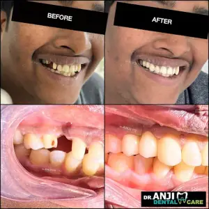 Dental Bridge Treatment