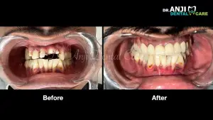 Full Mouth Rehabilitation