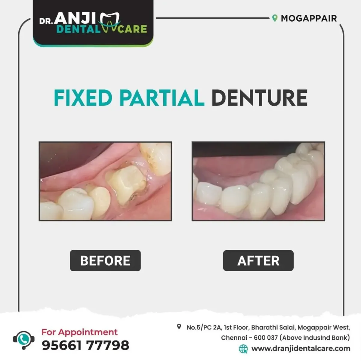 Fixed Partial Denture Treatment (FDA)