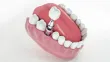 Full Mouth Dental Implants