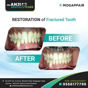 Restoration of Fractured Teeth