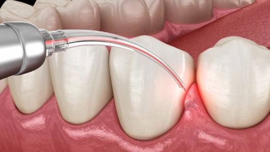 Laser Dentistry in Chennai