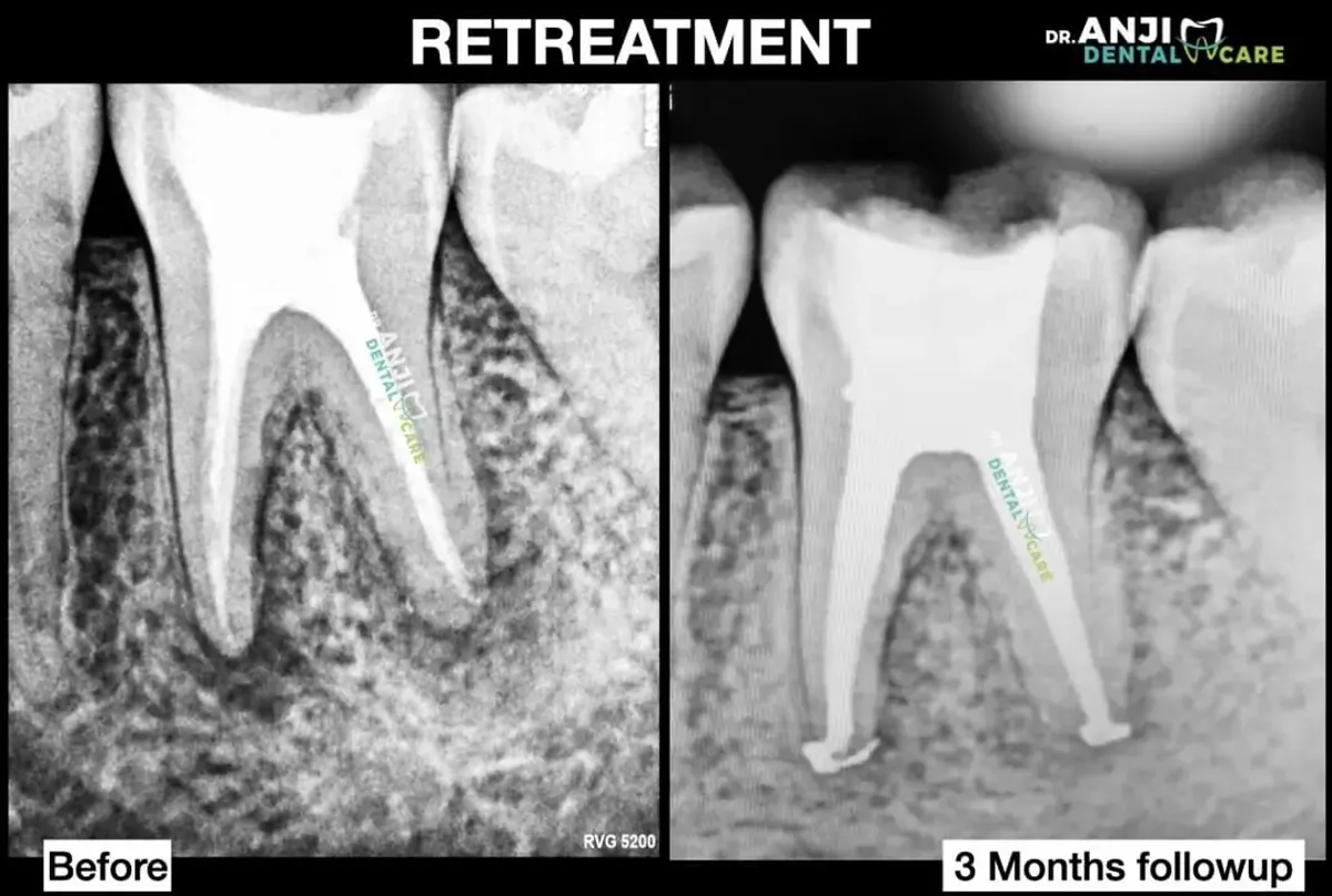 Magic of Re-RCT in 36