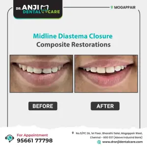 Midline Diastema Closure - Composite Restoration