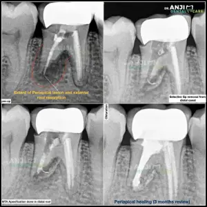 Re-RCT in 46 with Periapical Lesion and External Root Resorption