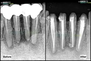 Re-RCT in Lower Anterior Teeth