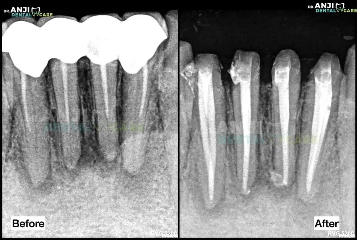 Re-RCT in Lower Anterior Teeth