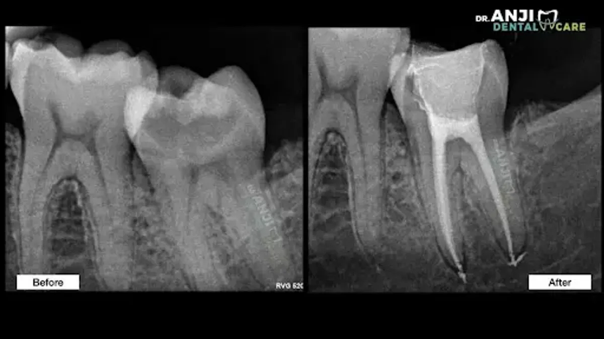 Root Canal Treatment