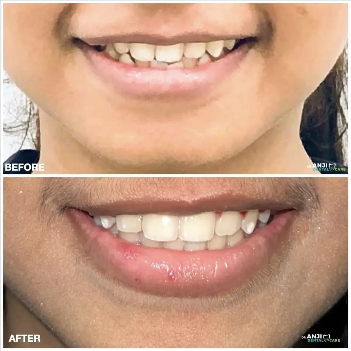 Smile Correction with Fixed Orthodontic Appliance