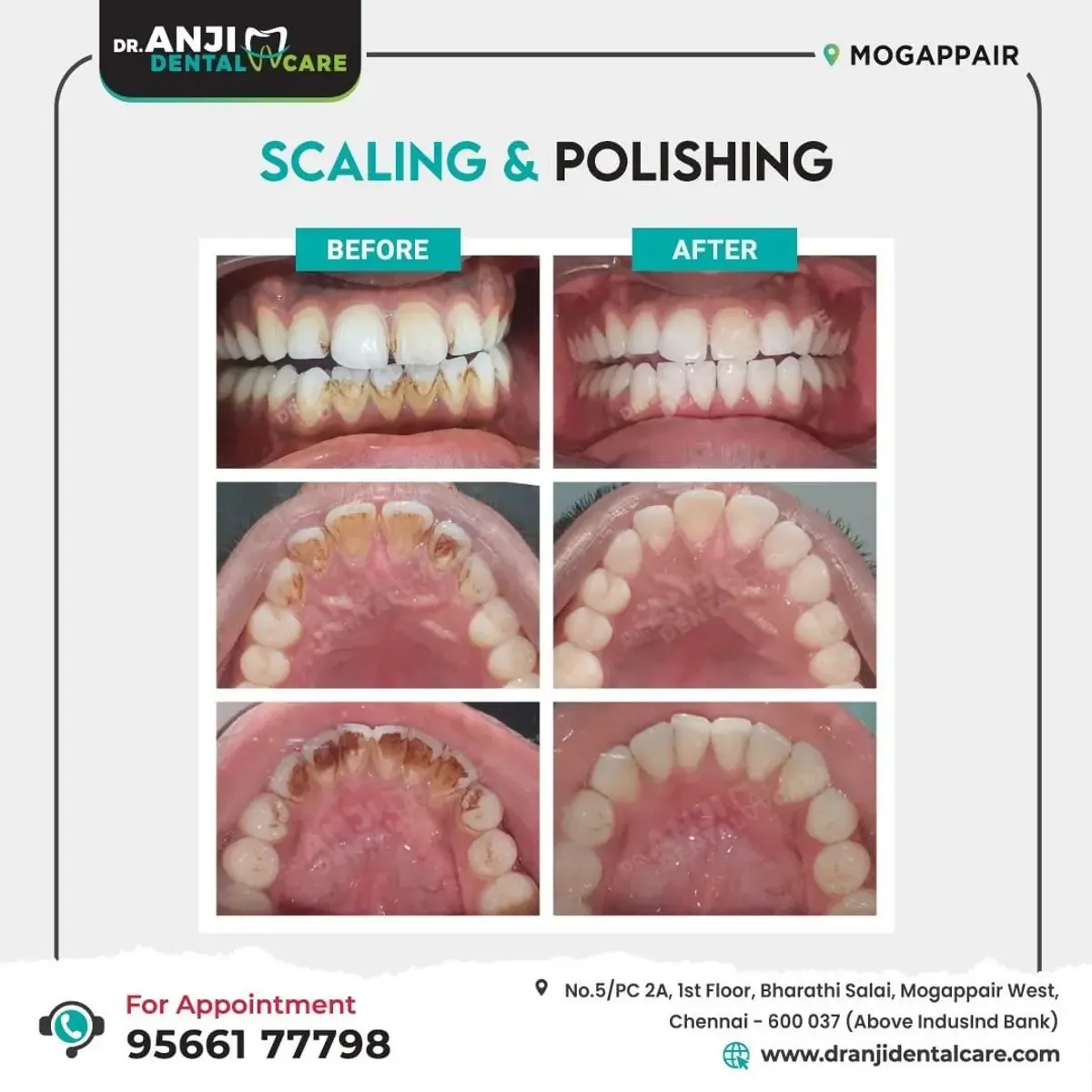 Scaling and Polishing Treatment