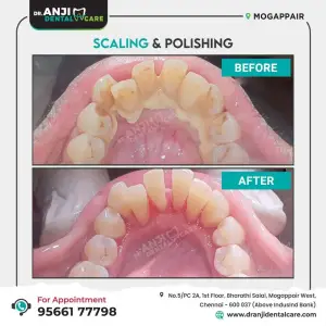 Teeth Scaling and Polishing Treatment