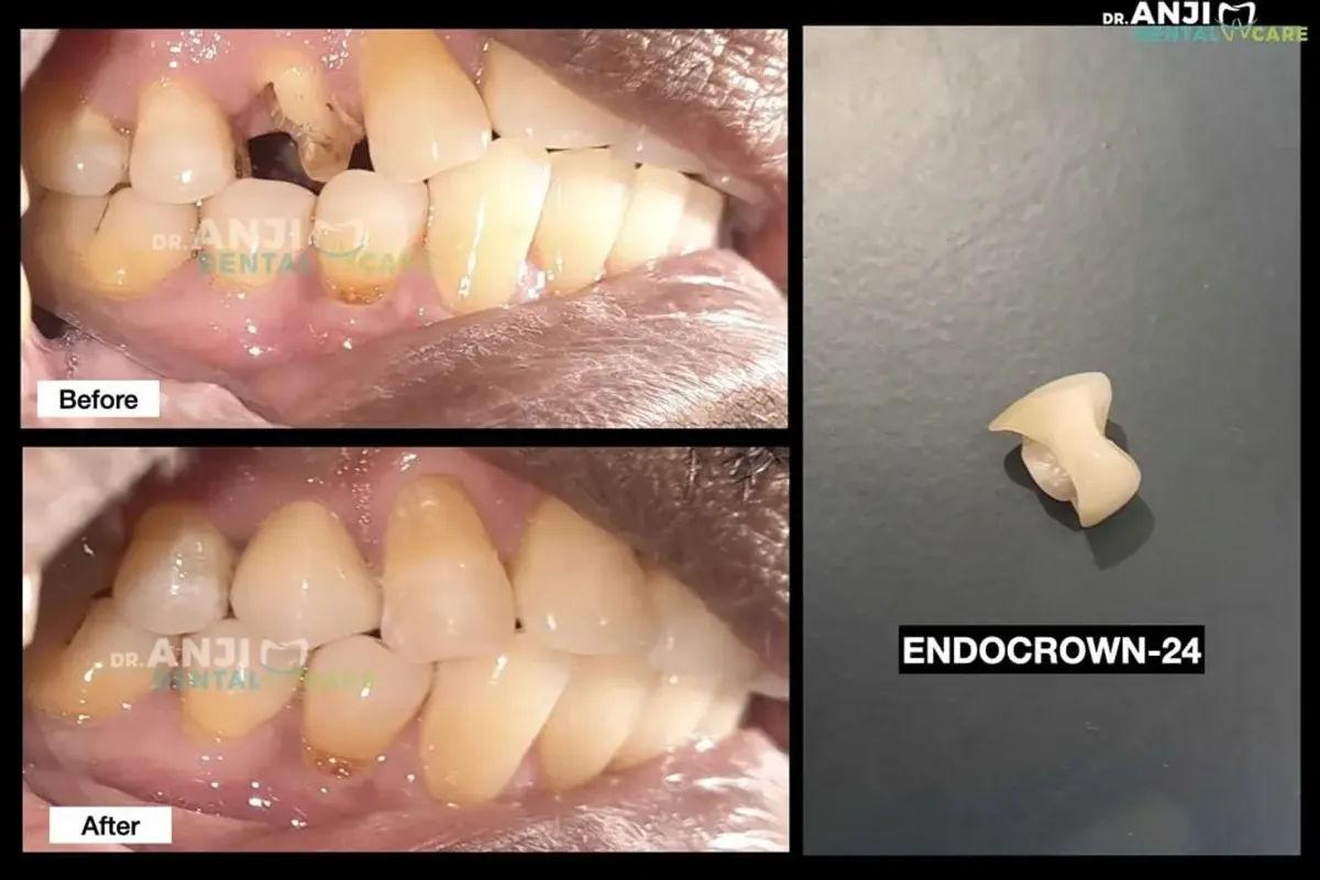 Zirconia Endo Crown in Relation to 24