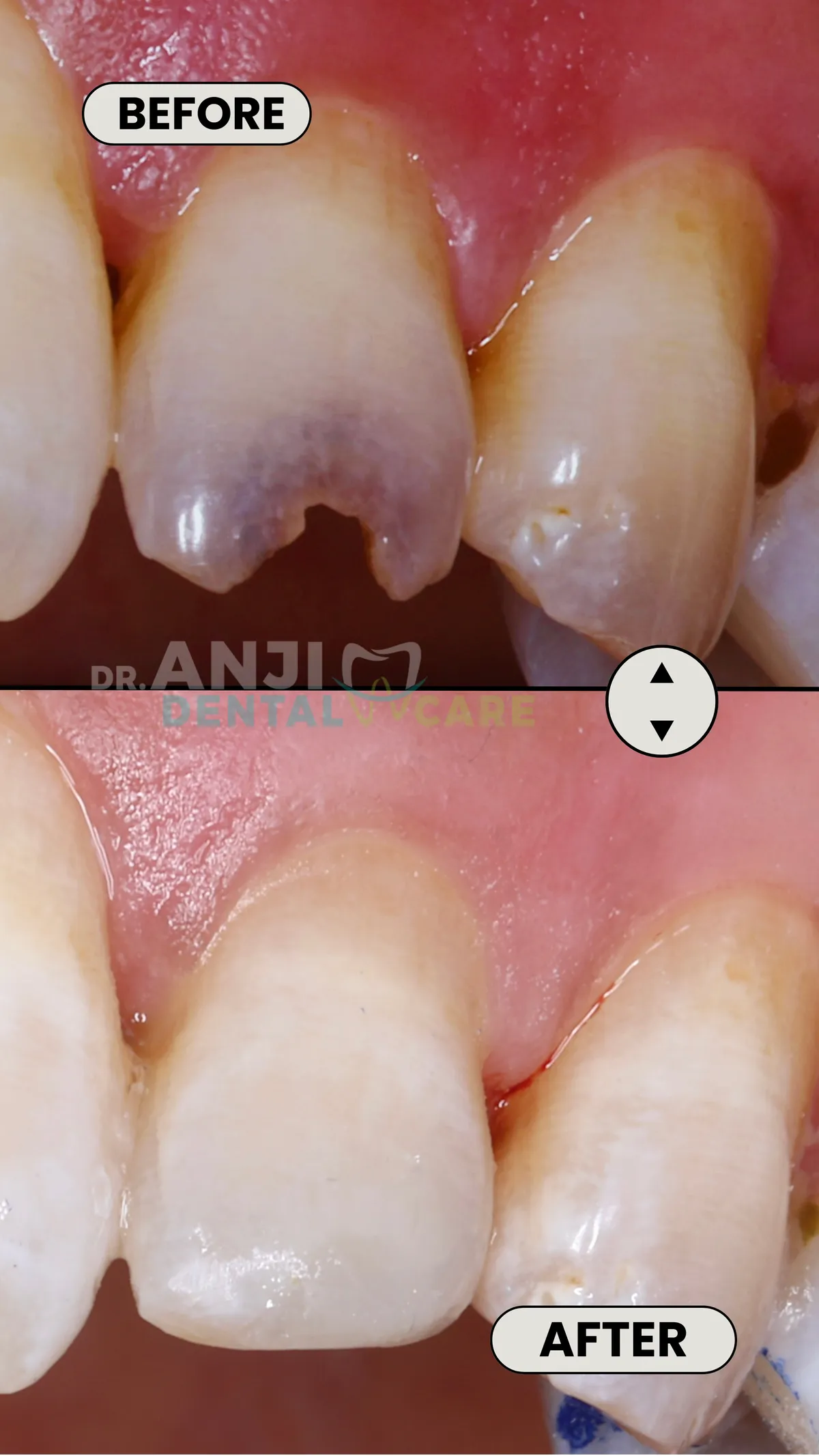 Composite Restoration Broken Tooth