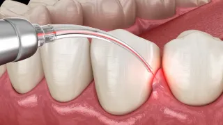 Dental Laser