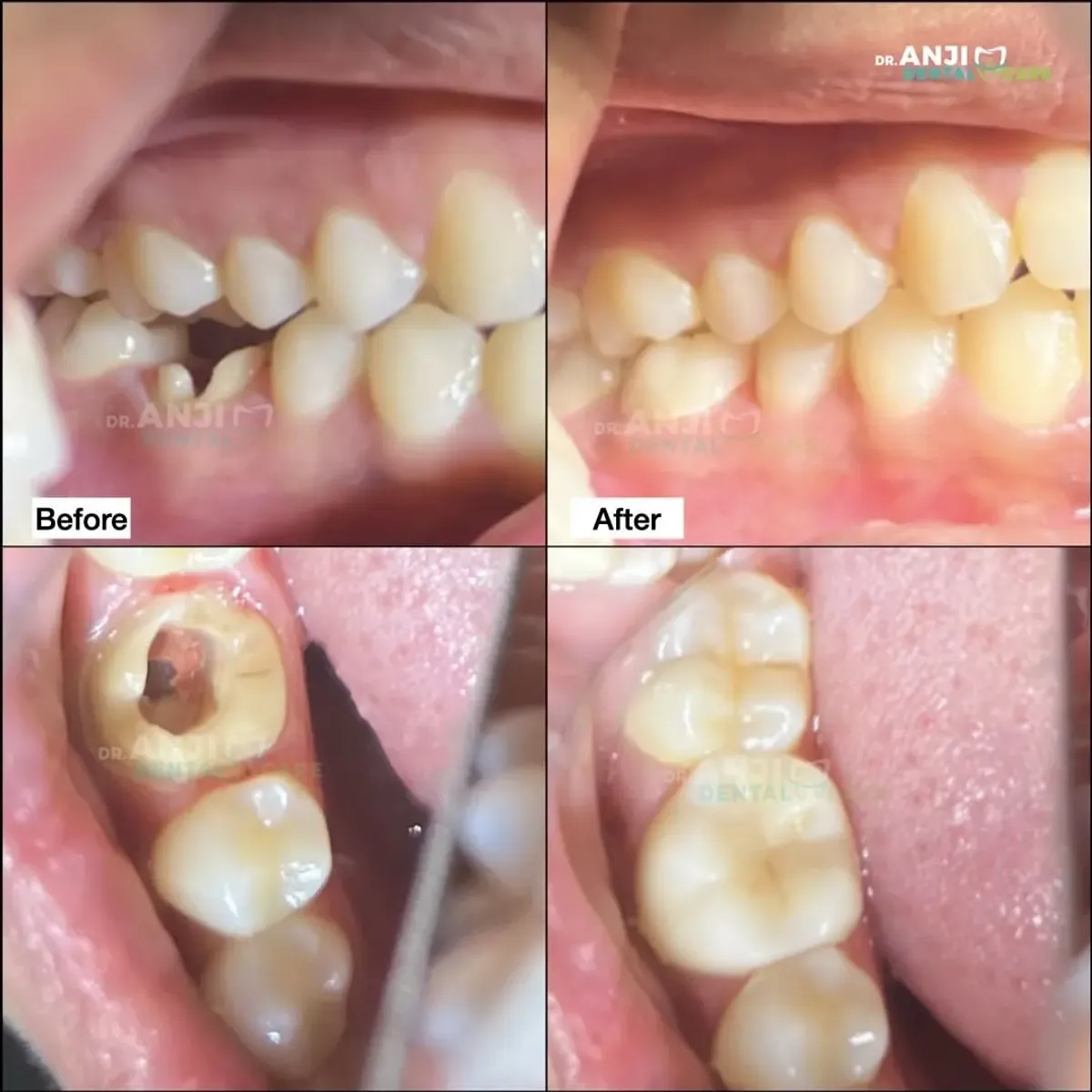 Zirconia Endo Crown