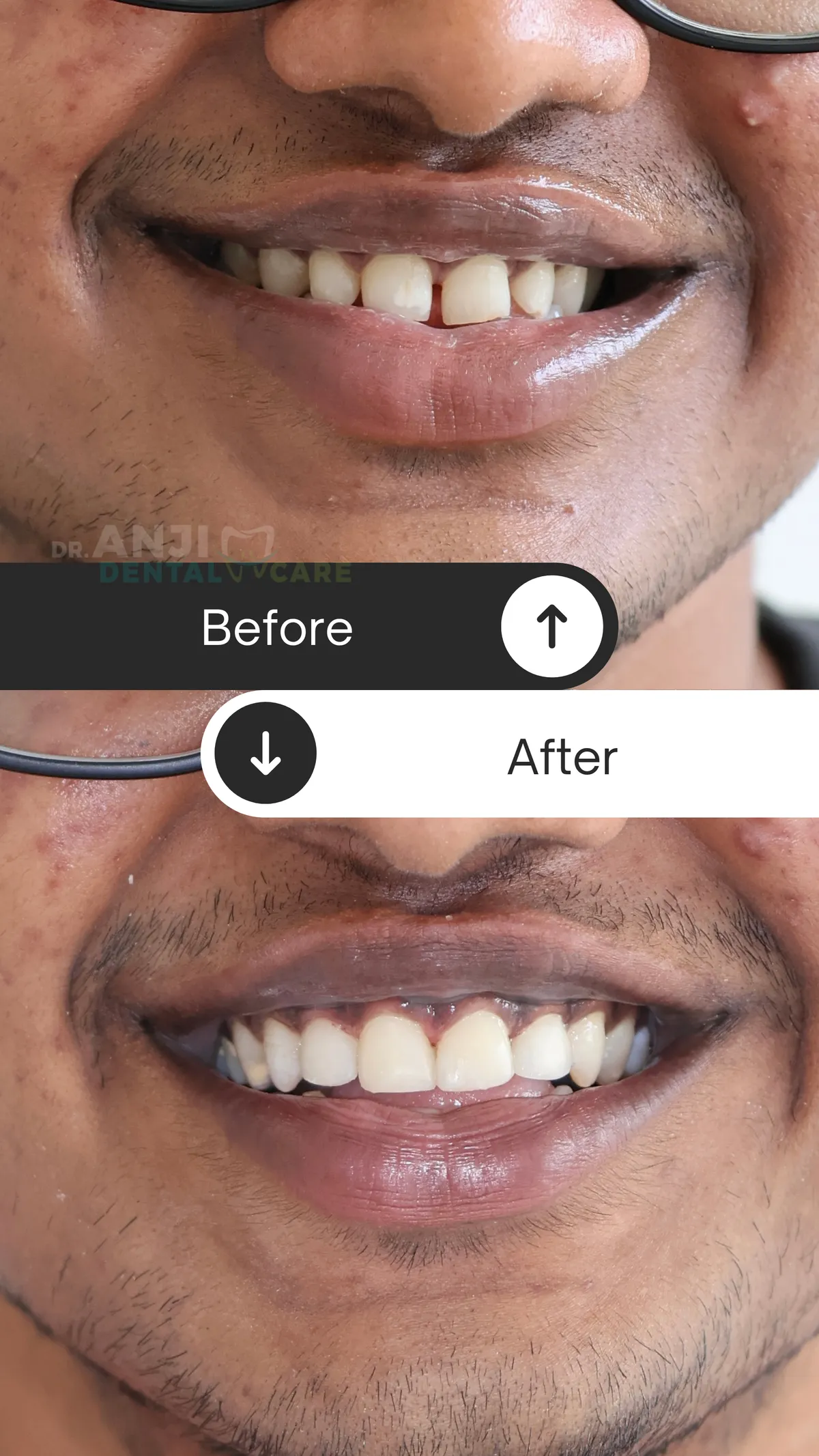 Composite Gap Filling Before and After