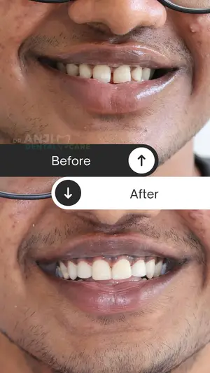 Composite Gap Filling Before and After