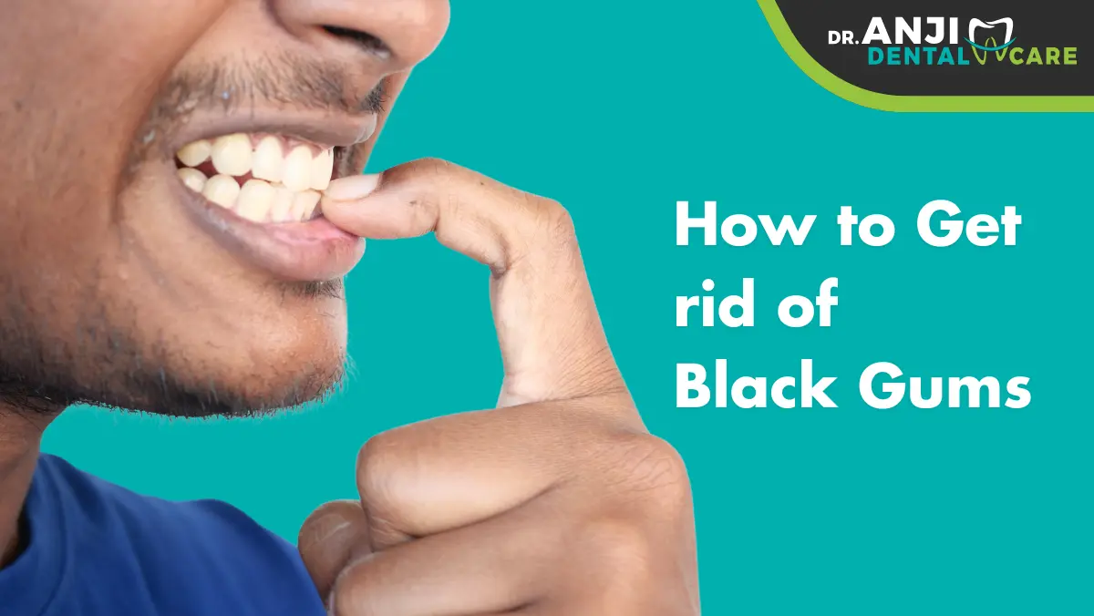 How to Get rid of Black Gums