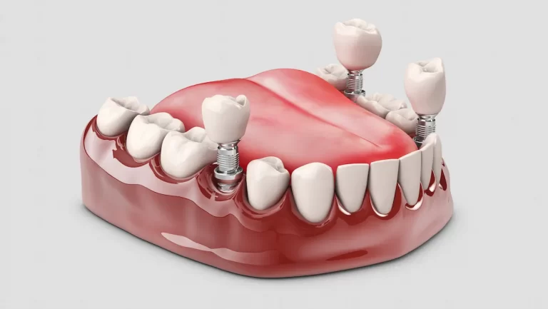 dental implants in nolambur | Dr. Anji Dental Care.