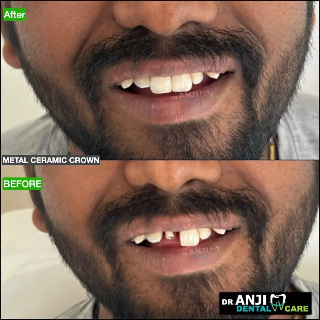 dental crowns in chennai | dranjidentalcare