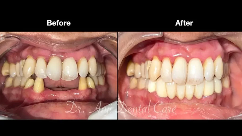Dentures | dranjidentalcare
