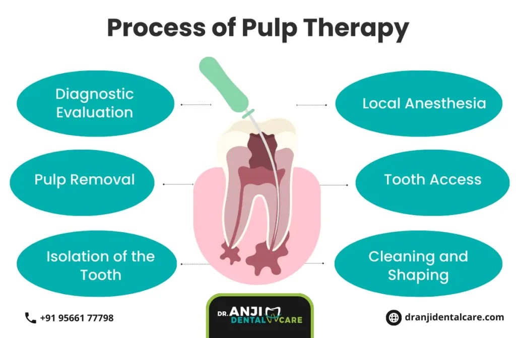 pulp therapy treatment in chennai
