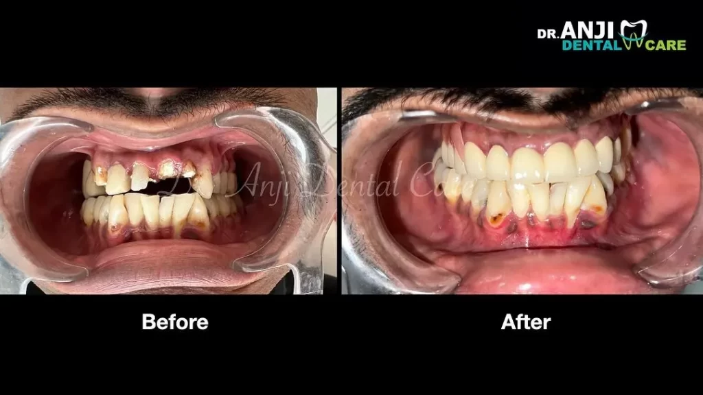 full mouth dental implants in chennai | Anji Dental Care