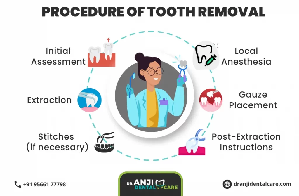 tooth removal cost in chennai | anjidental care