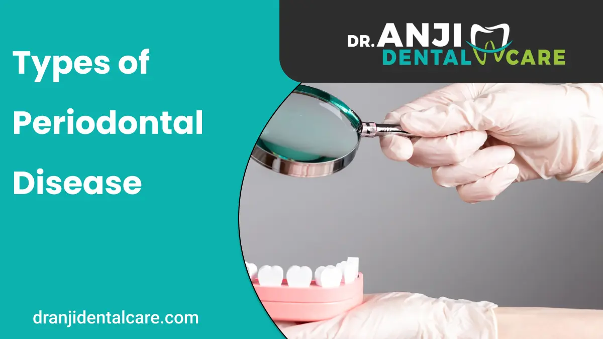types of periodontal disease | Anji dental care