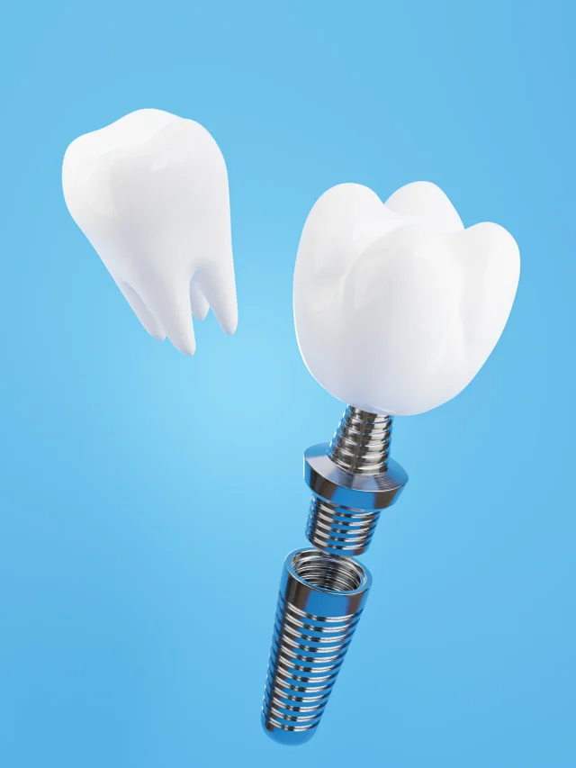 3d-render-dental-implant-assembly-blue-background